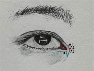 Clinical Application of a Bird-Beak-Type Z-Shaped Asymmetrical Flap in the Reconstruction of the Inner Canthus